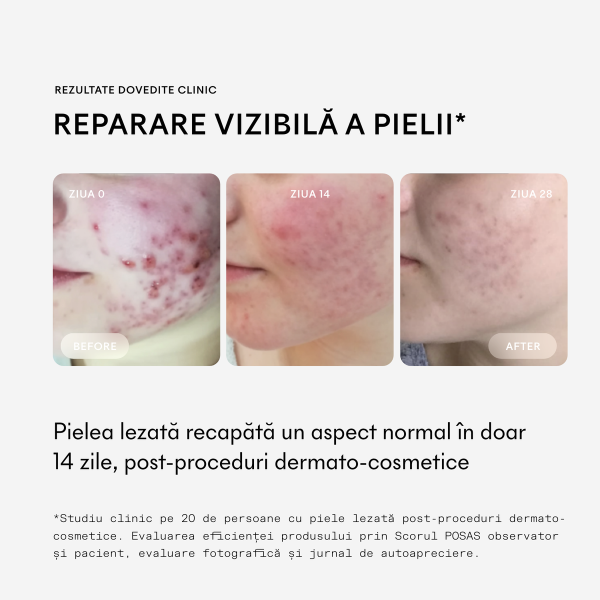 Cicaderm Spray reparator cu Mimosa tenuiflora pentru leziuni umede și piele sensibilă, 50 ml