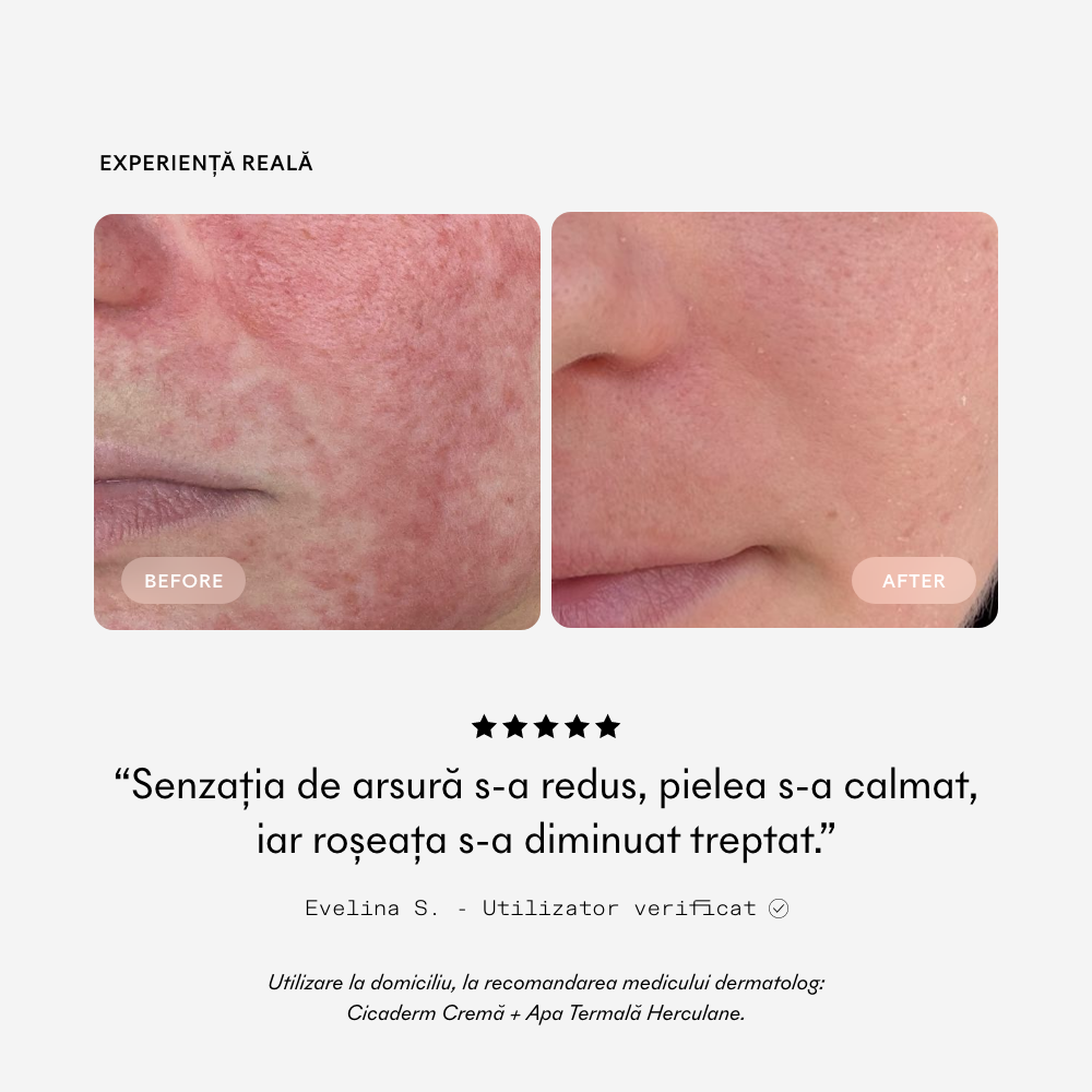 Experiență reală Ivatherm Cicaderm: comparație înainte și după pentru piele iritată și înroșită
