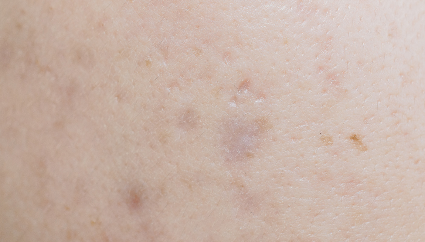Tipuri de cicatrici post acneice