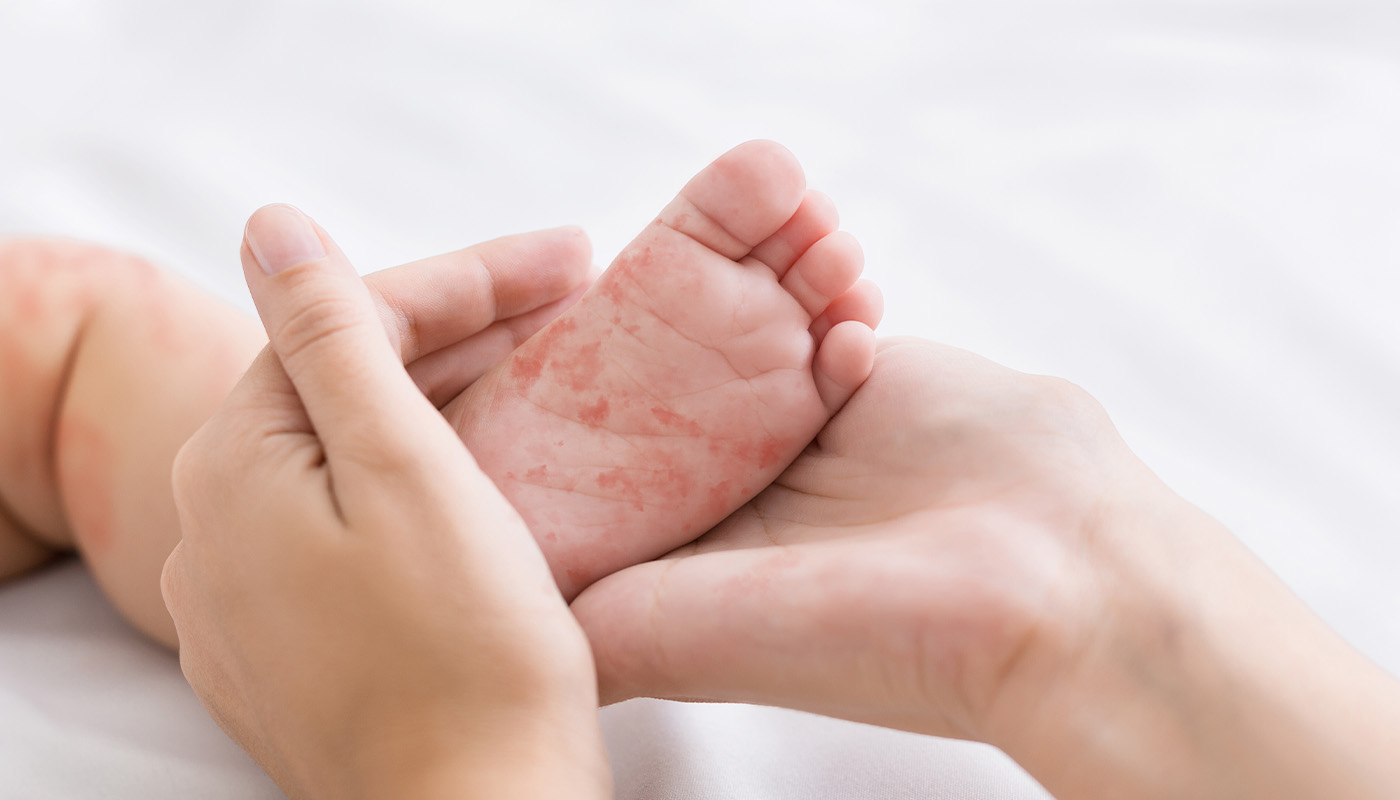 Dermatita bebelusi