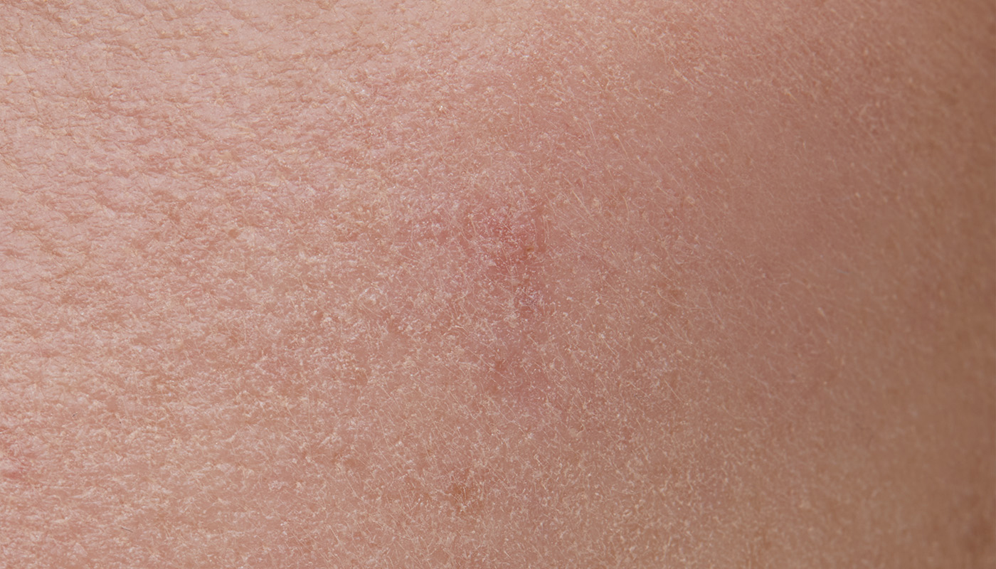 ce este dermatita seboreica