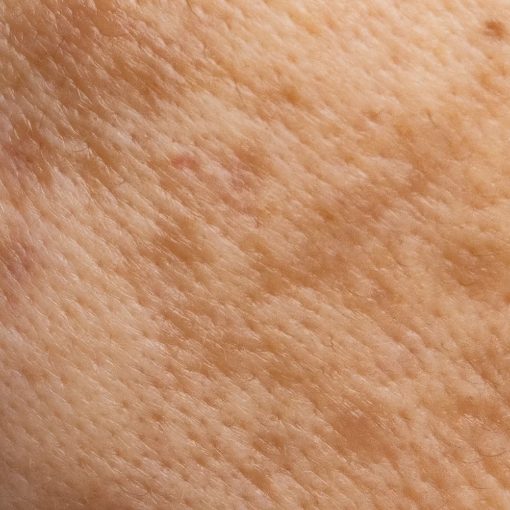 Hyperpigmented Skin