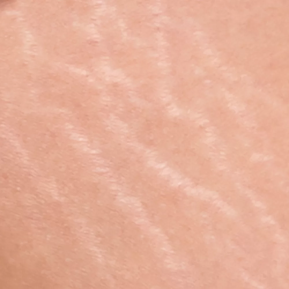 Skin with Stretch Marks